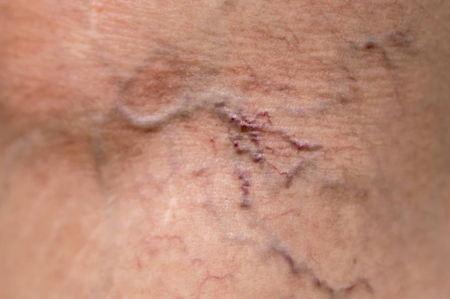 eliminar arañas vasculares