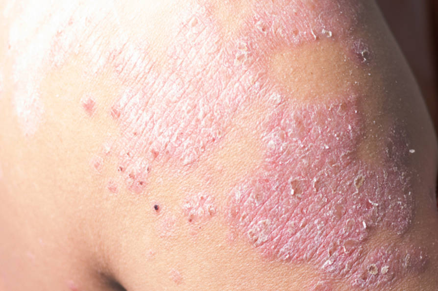 especialista psoriasis