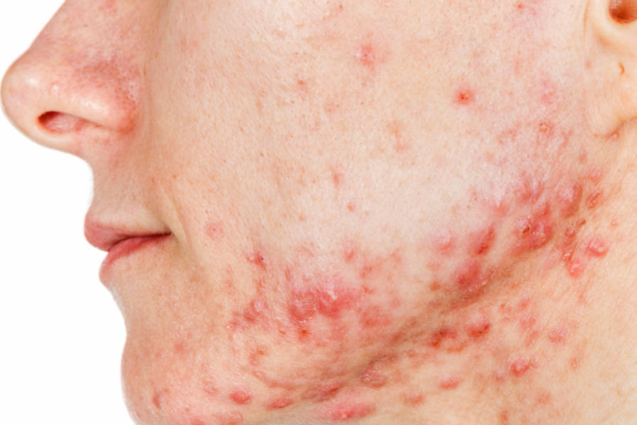 tratamiento acne