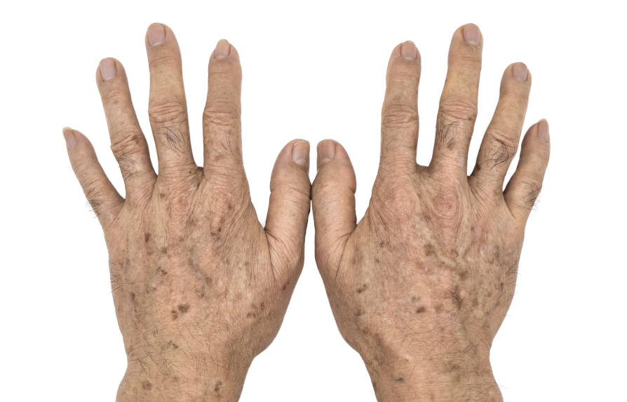 tratamiento lentigos solares